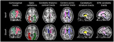 Structural and connectivity parameters reveal spared connectivity in young patients with non-progressive compared to slow-progressive cerebellar ataxia